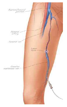catheter insertion in thigh vein for VNUS EVLT